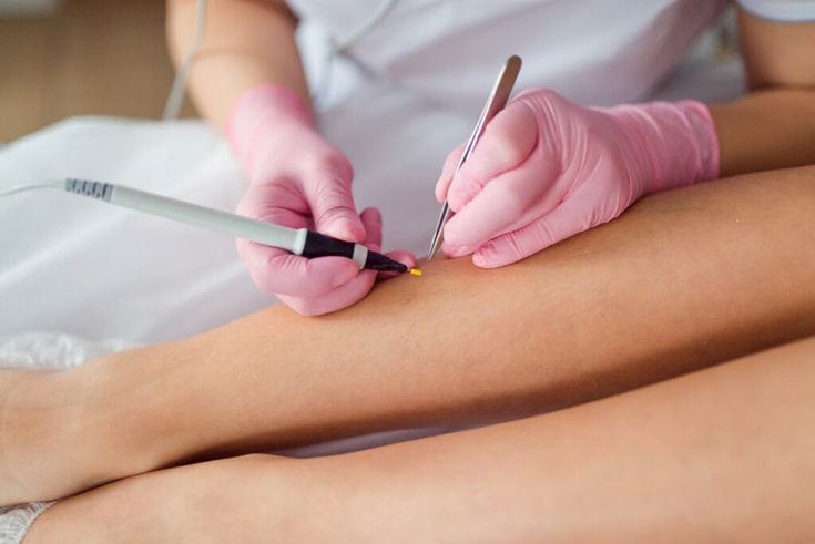 Electrólisis Definitiva Corporal