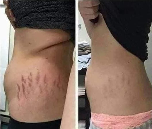 Tratamiento para Estrías