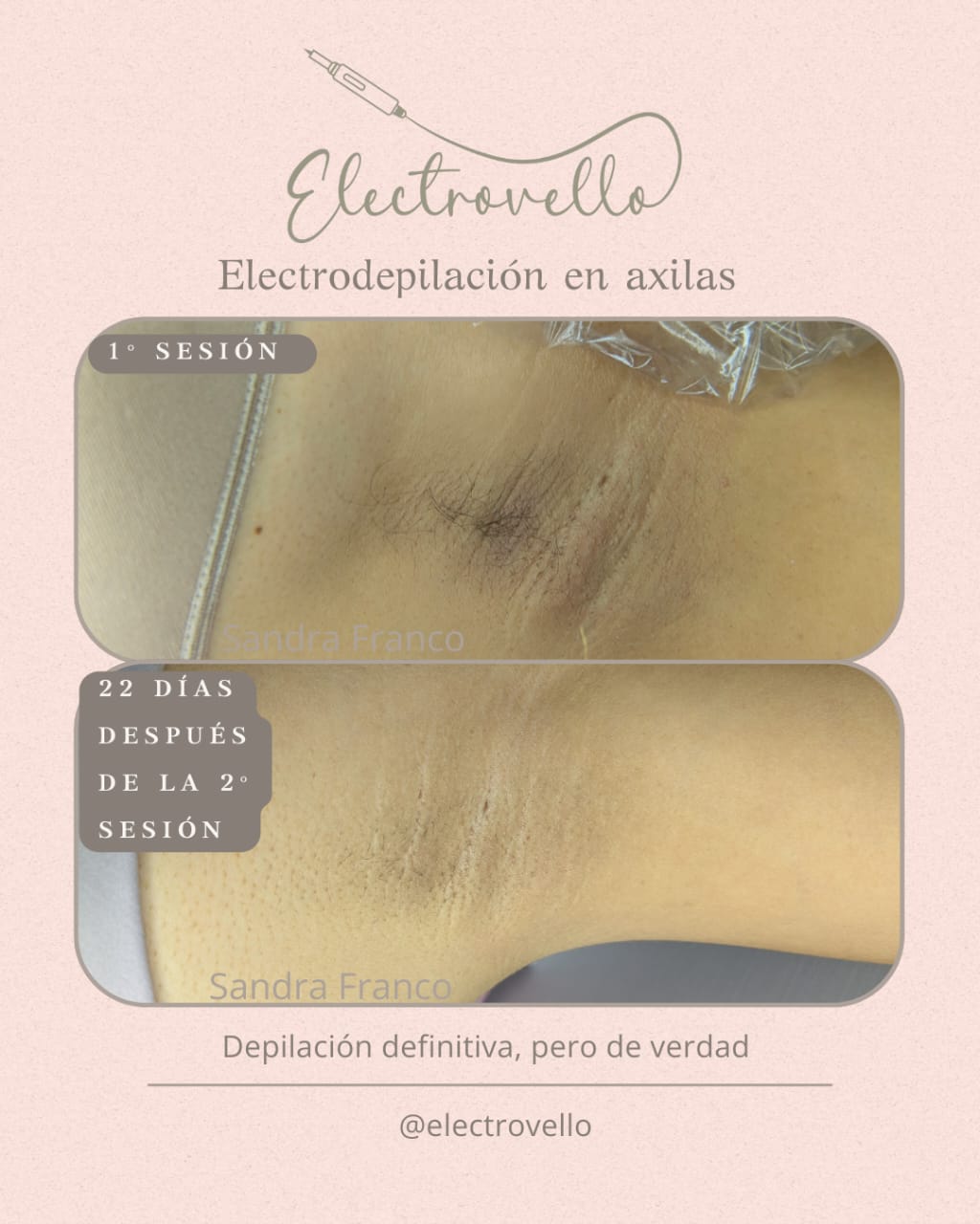 Depilación definitiva con enfoque ético